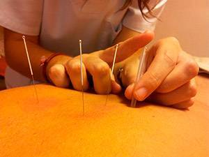 acupuntura